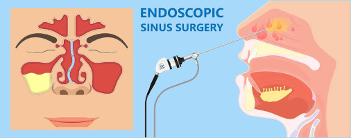 FESS surgery